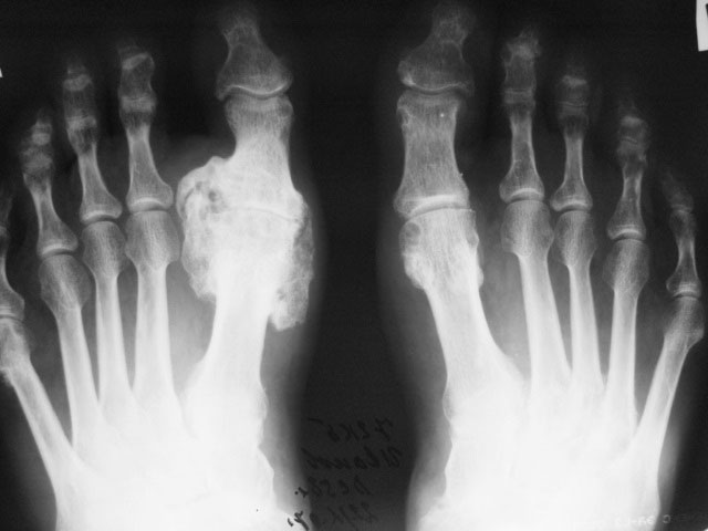 рентгеновский снимок стоп при подагре