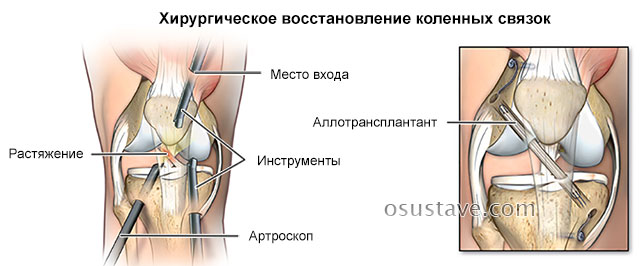 хирургическое восстановление коленных связок