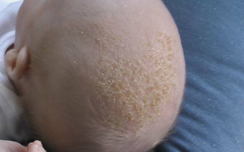 Что вызывает сыпь на лице у ребёнка?