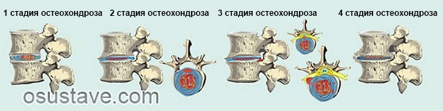 4 стадии остеохондроза