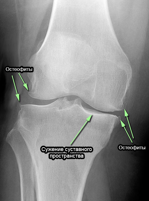 рентген коленного сустава с остеофитами