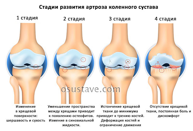 4 стадии развития артроза колена