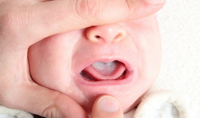Молочница во рту у грудничка фото лечение
