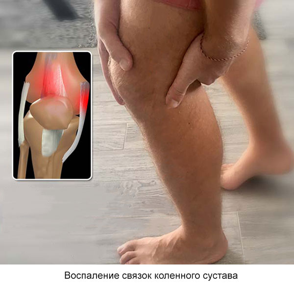 воспаление связок коленного сустава