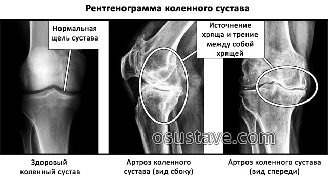 рентгенограмма коленного сустава
