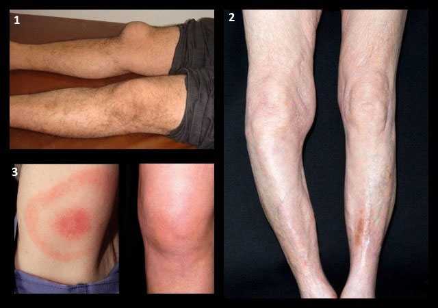 бурсит коленного сустава, болезнь Педжета, инфекционный артрит при болезни Лайма