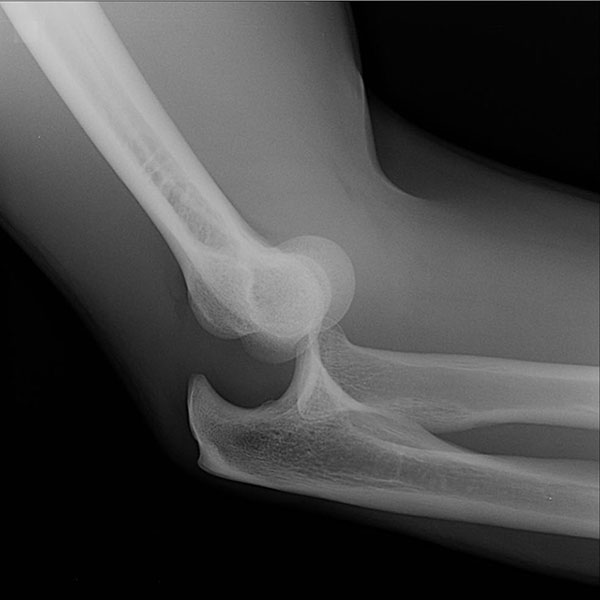 рентгенограмма при вывихе локтевого сустава