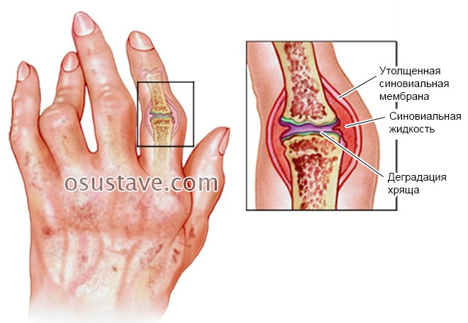 изменения в пальцах при прогрессировании заболевания
