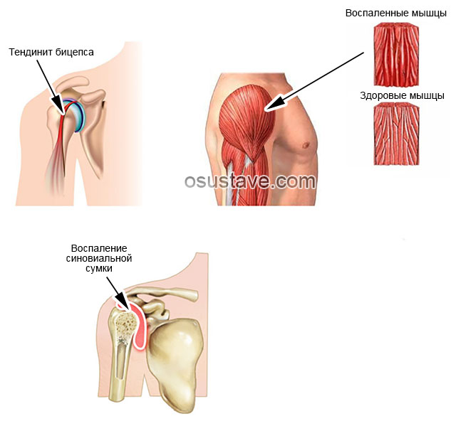 воспалительные процессы в различных тканях плеча
