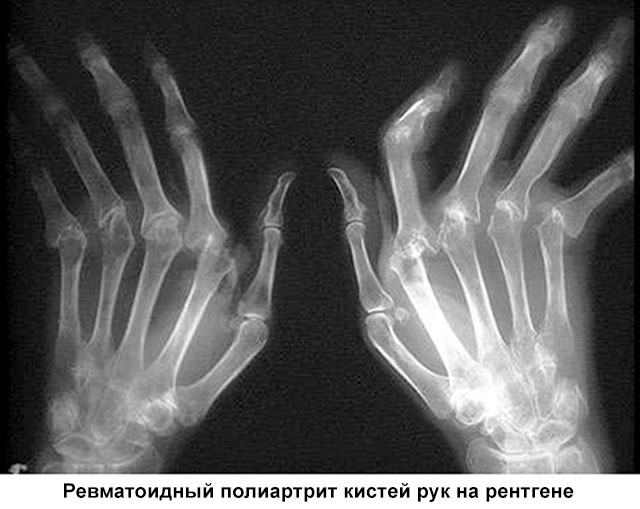 ревматоидный полиартрит кистей рук на рентгене