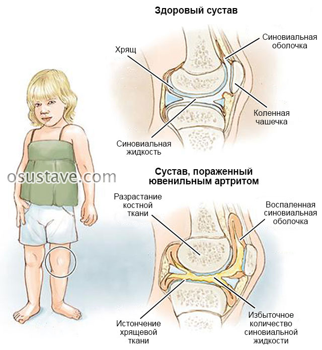 ювенильный ревматоидный артрит у маленькой девочки