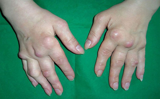 полиартрит суставов пальцев рук