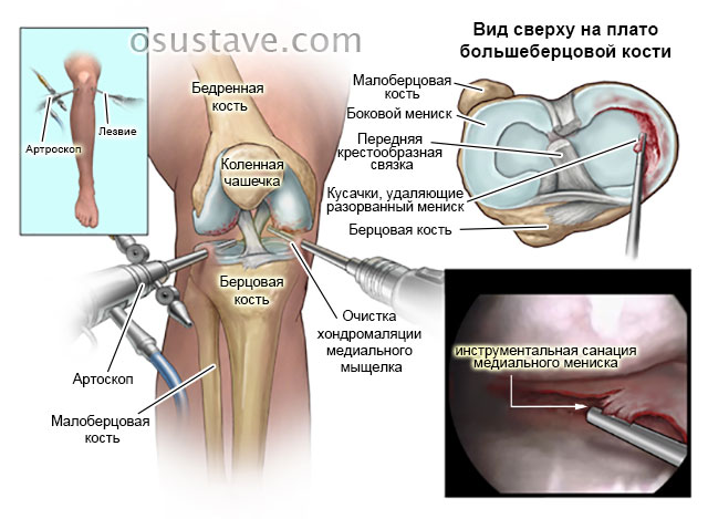 схематичное изображение артроскопии коленного сустава