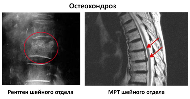 МРТ и рентген грудного отдела при остеохондрозе