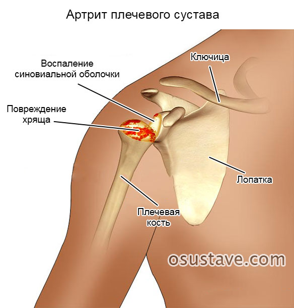 ревматоидный артрит плечевого сустава