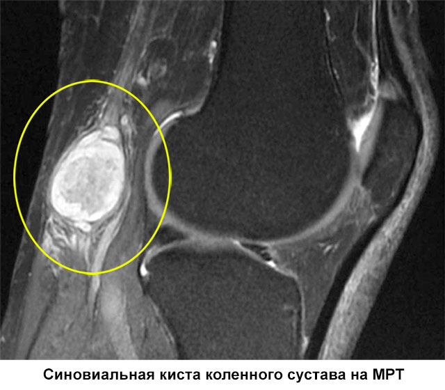 синовиальная киста коленного сустава на МРТ