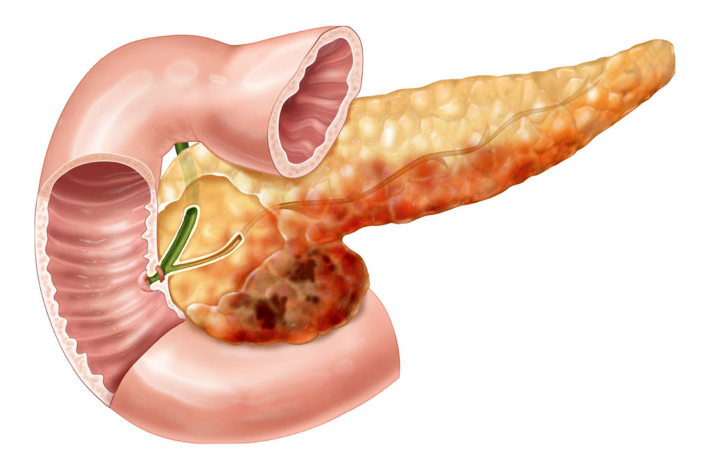 Стеатоз поджелудочной железы