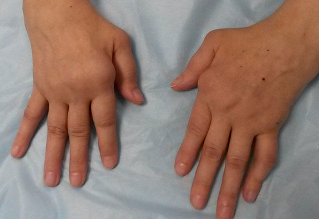 деформация суставов пальцев рук при ЮРА