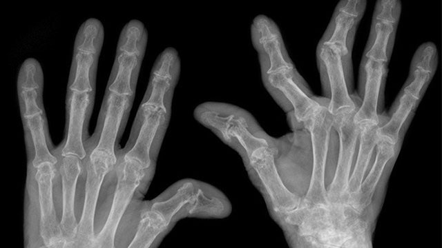 рентгеновский снимок рук, пораженных артритом