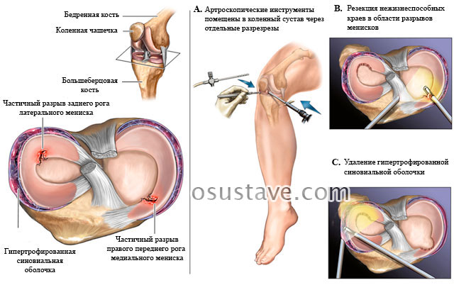 артроскопическая операция при повреждении (частичных разрывах) мениска