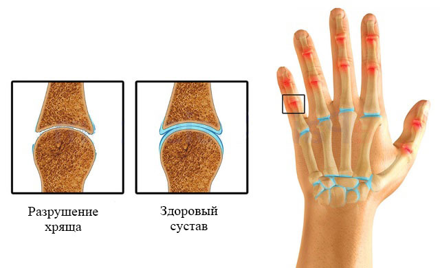 полиостеоартроз суставов пальцев кисти