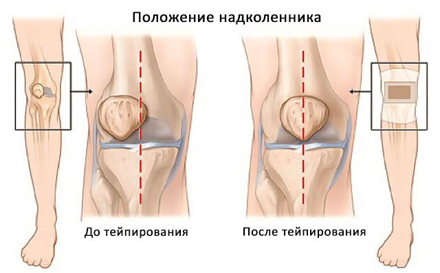 коленный сустав до и после тейпирования