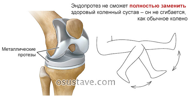коленный сустав после операции по протезированию