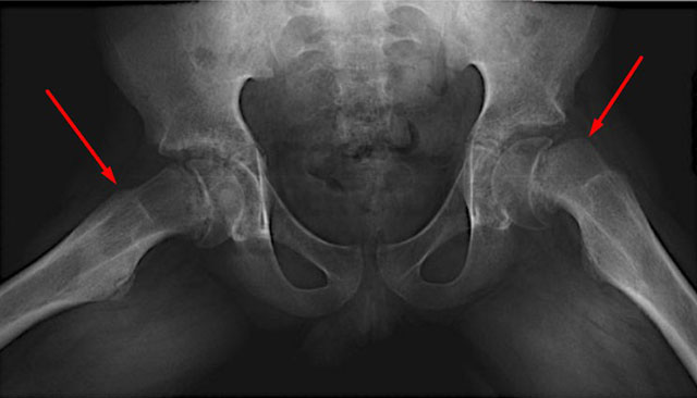рентгеновский снимок двухстороннего эпифизеолиза у подростка 12 лет