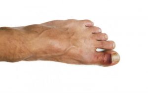 Перелом пальца на ноге. Симптомы, диагностика и лечение