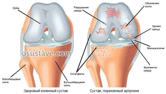 здоровый коленный сустав и пораженный артрозом