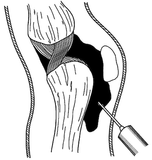пункция нижних заворотов колена