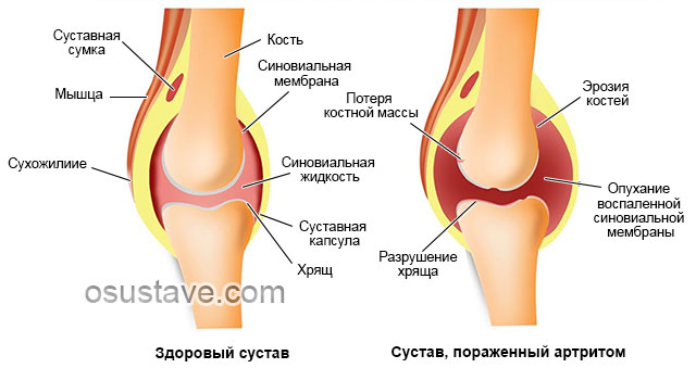 здоровый коленный сустав и пораженный артритом