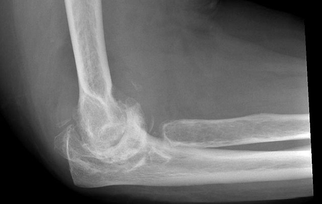 рентгенограмма локтевого сустава, пораженного артритом