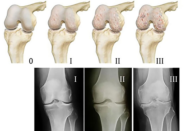 рентгенограмма артроза коленного сустава трех степеней