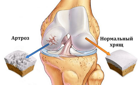 различия строения хряща коленного сустава в норме и при артрозе