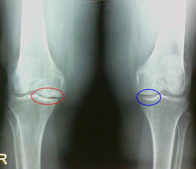рентгенография коленного сустава при гонартрозе и нормальный коленный сустав