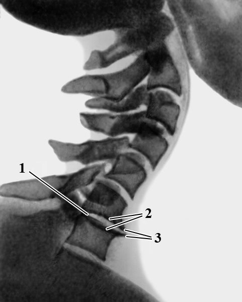 рентгенограмма шейного отдела позвоночника при субхондральном склерозе
