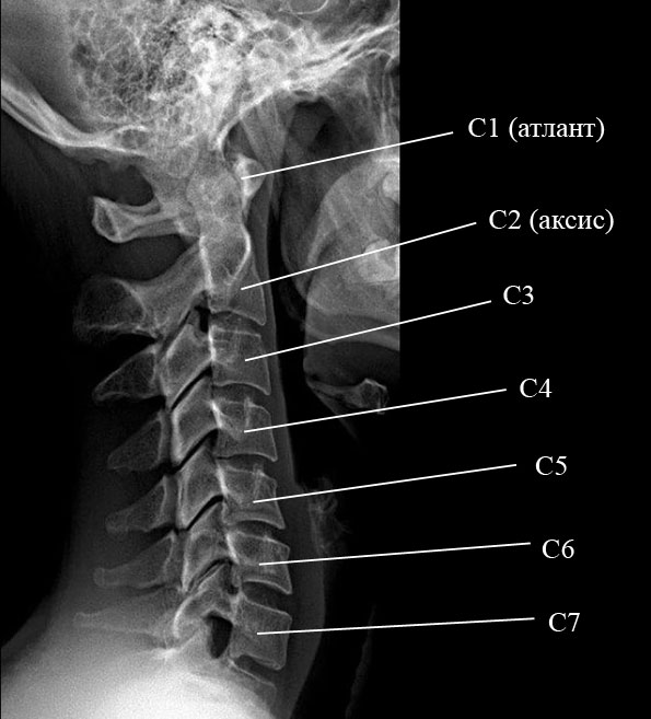 рентген шейного отдела позвоночника