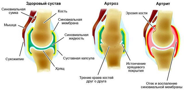 артроз и артрит сустава