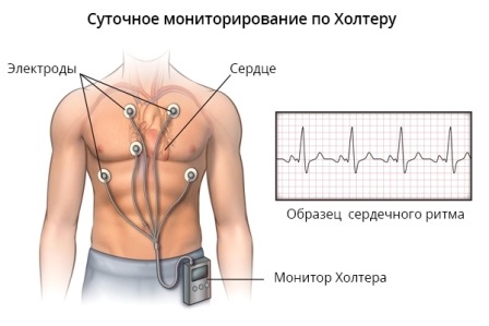 Метод с помощью которого осуществляется суточное наблюдение за работой сердца