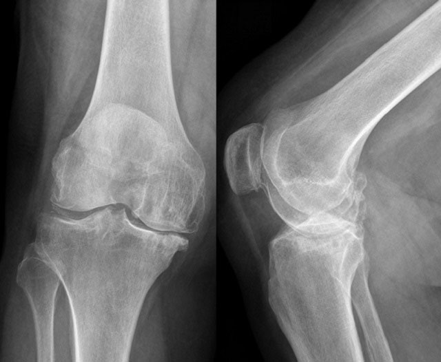рентген коленного сустава
