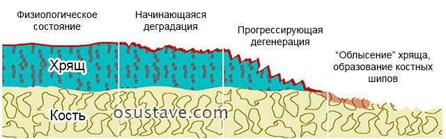 процесс разрушения хрящевой ткани