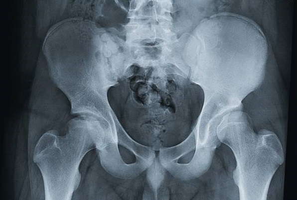 рентгенография тазобедренного сустава с дисплазией