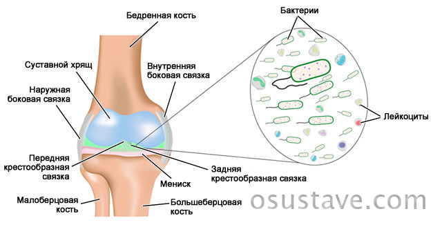 септический артрит колена