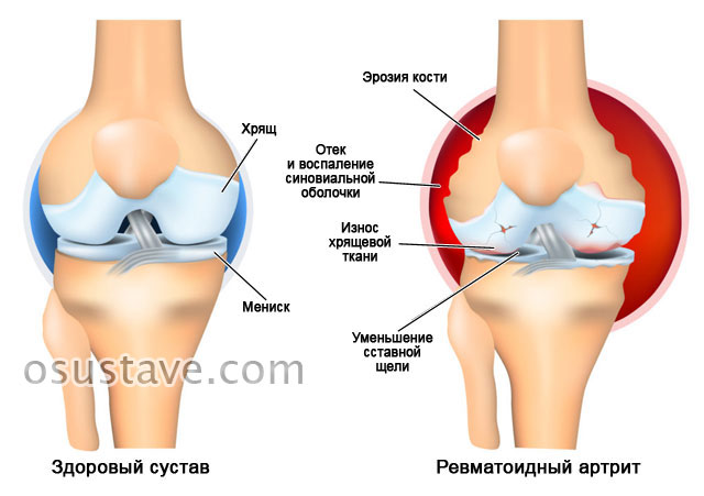 ревматоидный артрит колена