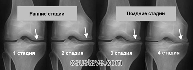 4 стадии артрита на рентгеновских снимках