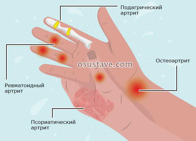 проявления различных видов артрита пальцев рук